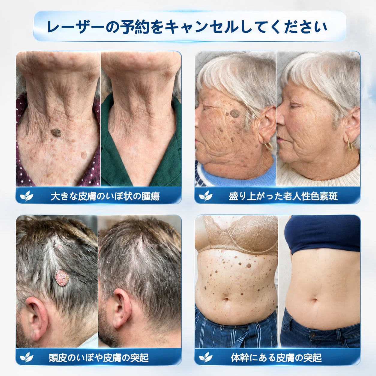 🖋️Twisma® ピンポイント角質ケアローラー｜🔥首元・デコルテの気になるポツポツ・ザラつきをやさしく集中ケア🌿