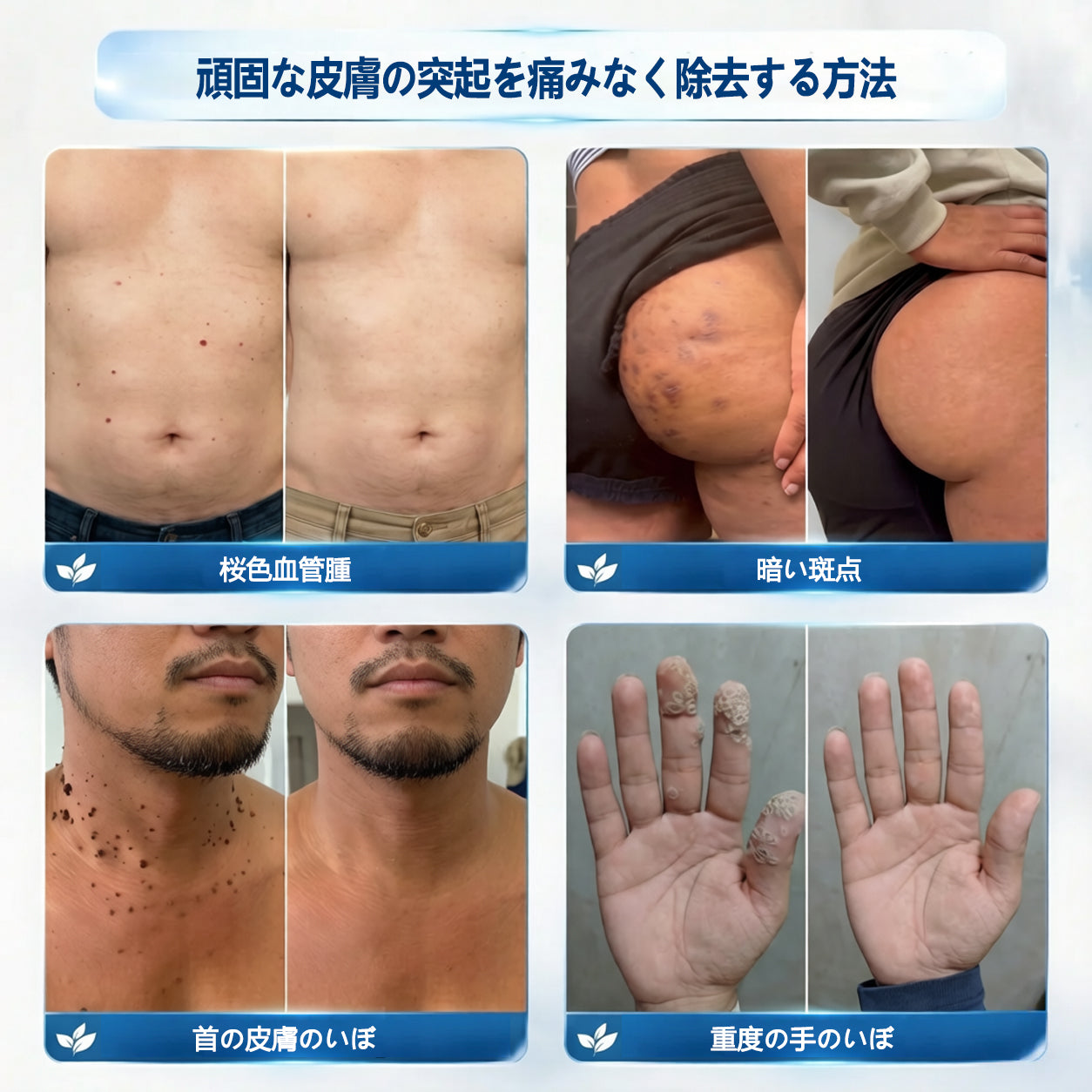 🖋️Twisma® ピンポイント角質ケアローラー｜🔥首元・デコルテの気になるポツポツ・ザラつきをやさしく集中ケア🌿