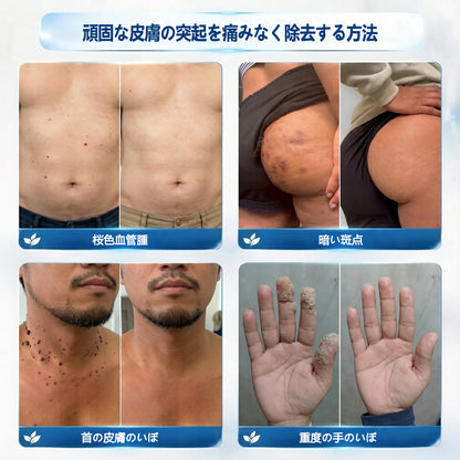 🖋️Twisma® ピンポイント角質ケアローラー｜🔥首元・デコルテの気になるポツポツ・ザラつきをやさしく集中ケア🌿