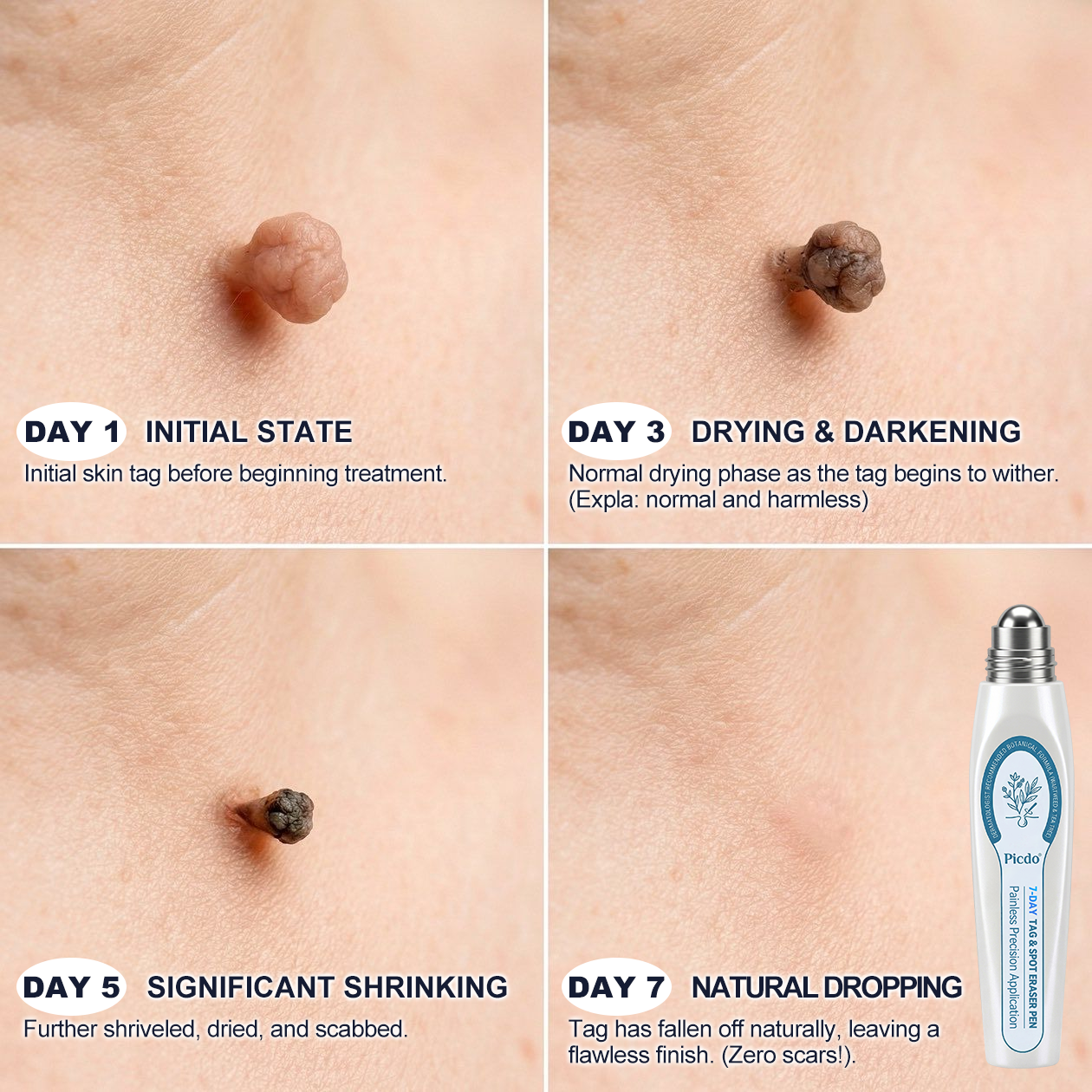 𝐏i𝐜𝐝o®🩹7-𝐷𝑎𝑦 𝗧𝐚𝐠 & 𝗦𝗽𝐨𝐭 𝐄𝐫𝒂𝒔𝒆𝒓(Zero Pain, Zero 𝐒𝐜𝐚𝒓𝒔 Rollerball)💥
