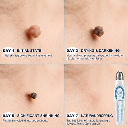 𝐏i𝐜𝐝o®🩹7-𝐷𝑎𝑦 𝗧𝐚𝐠 & 𝗦𝗽𝐨𝐭 𝐄𝐫𝒂𝒔𝒆𝒓(Zero Pain, Zero 𝐒𝐜𝐚𝒓𝒔 Rollerball)💥